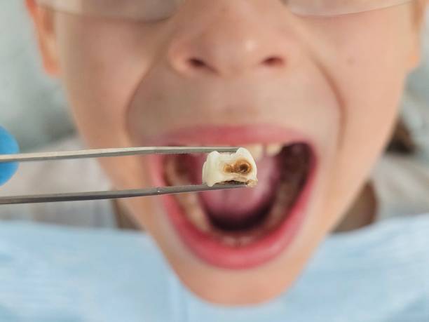 Best Tooth Infection Emergency Dentist  in Perryton, TX
